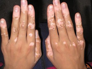 WITILIGO (PIS AÇMA) KESELI: SEBÄPLERI, BEJERGISI, ÖŇÜNI ALYŞ ÇÄRELERI