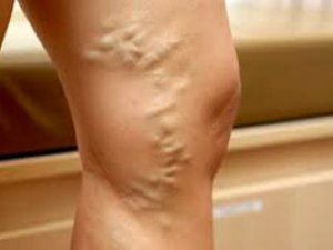 AÝAGYŇ TROMBOFLEBIT KESELI: SEBÄPLERI, ALAMATLARY, GAÝRAÜZÜLMELERI, BEJERGISI WE ÖŇÜNI ALYŞ ÇÄRELERI