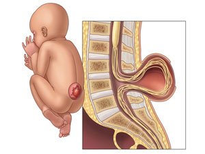 SPINA BIFIDA: SEBÄBI, ALAMATLARY, BEJERGI AÝRATYNLYKLARY