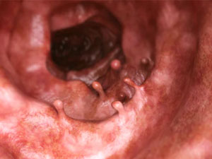 goni iceganin rak keseli