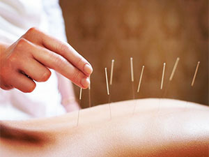 akupunktura